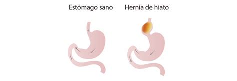 Hernia Hiatal Qu Es Causas S Ntomas Y Tratamiento Centro Medici