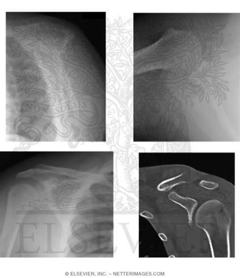 Shoulder Anatomy Radiology