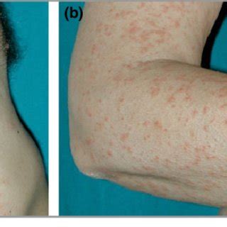 Erythematous papular dermatitis with some central tense vesicles and ...