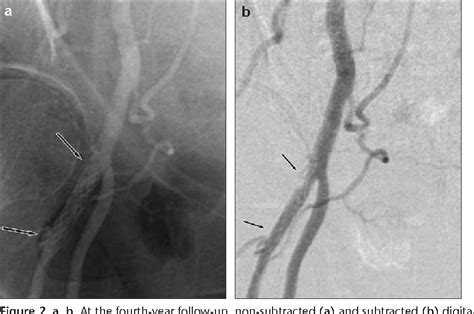 Figure From Iatrogenic Femoral Arteriovenous Fistula Endovascular