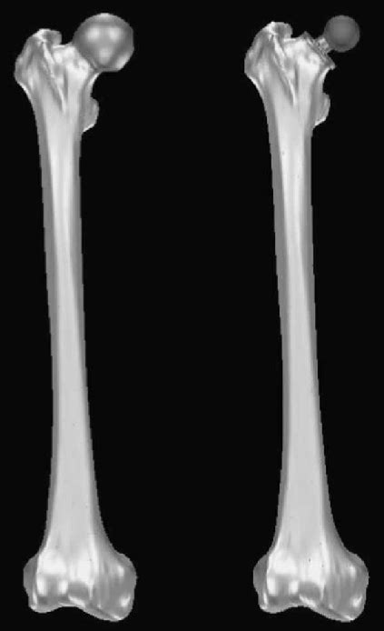 Intact And Reconstructed Femur Models Illustrating The Bone Volume