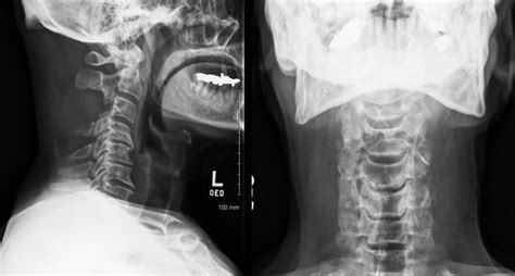 Metastatic Disease Of Spine Pathology Orthobullets