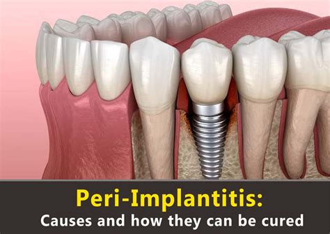 Peri Implantitis Causes And How They Can Be Cured Dr Bhimani