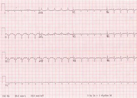 Pedi cardiology: EKG: Low Voltage Complexes & Lead Misplacement