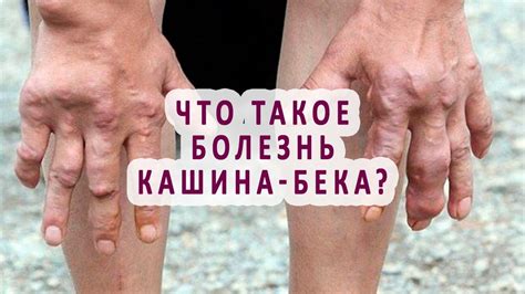 Что такое болезнь Кашина-Бека? - YouTube