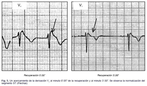 Alteraciones electrocardiográficas infrecuentes durante la prueba de