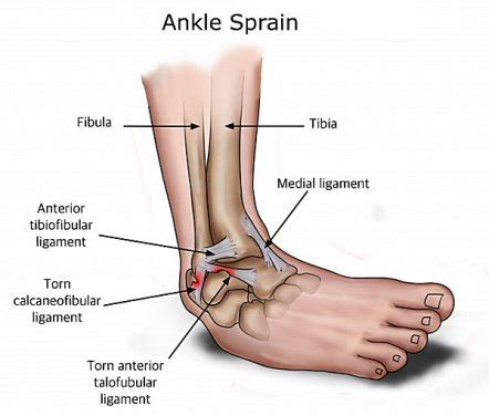 Ankle Sprains Cobram Physio