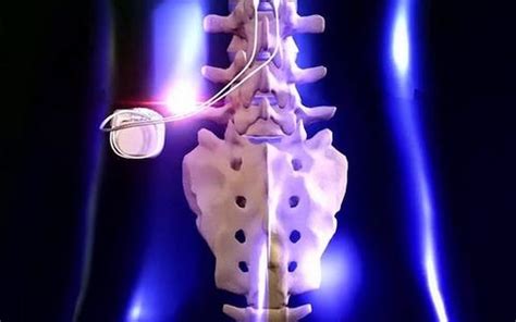 Spinal Stimulation And Physical Therapy Helps Paraplegic Patients To Walk Again Lifecrest