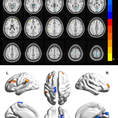 Spontaneous Brain Activity In The Monocular Blindness And Healthy