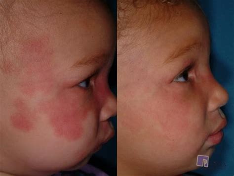 Port Wine Stains Red Skin Patch Removal By Tucson Experts