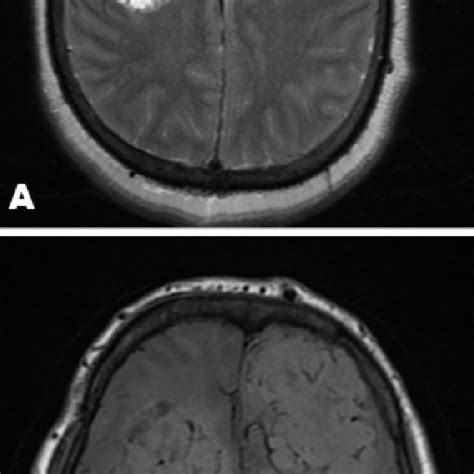 Axial T1 Weighted A And Axial T2 Weighted B Mri Images Reveal A