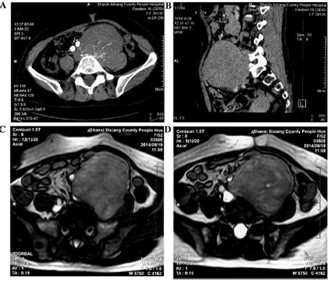 Abdominal Ct Scan Revealing A 10x9x8 Cm Low Density Soft Tissue Download Scientific Diagram