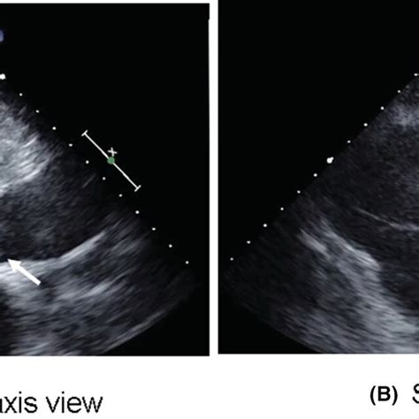 Transthoracic Echocardiograms Show Vegetations Visible In The