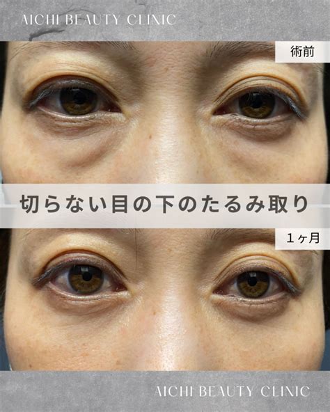 40代女性 目の下の切らないたるみ取り（経結膜脱脂術） 吉田dr あいちビューティークリニック｜愛知・jr「安城」駅徒歩1分の美容皮膚科・美容外科