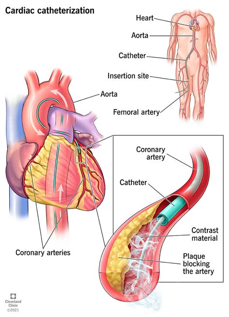 Cardiac Catheterization Purpose Procedure And Recovery