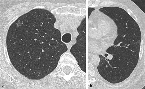 Elements Of A Successful Lung Cancer Screening Program Thoracic Key