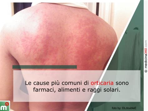 Orticaria Sintomi Cause Cura E Tipologie Acuta Cronica Da Stress