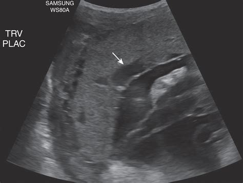 Placenta Clinical Tree