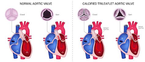 Understanding Aortic Stenosis Dr Raghu