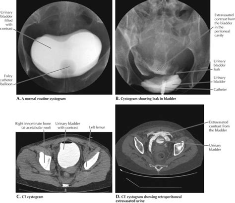 Male Vs Female Pelvis X Ray