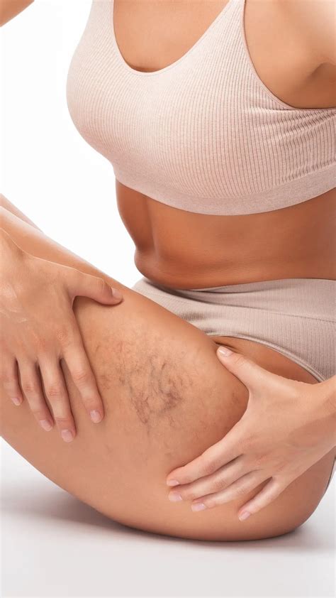 Spider And Thread Veins Laser Beauty Clinic