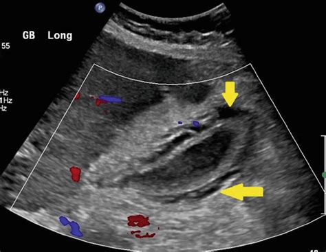 Acute Acalculous Cholecystitis Springerlink