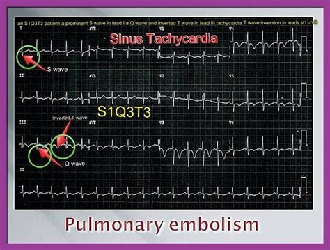 S1q3t3 Pulmonary Emboli My Love And Passion Pinterest