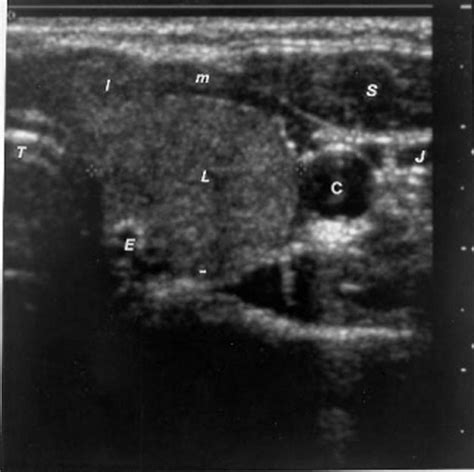 Ultrasonography Of The Thyroid Thyroid Disease Managerthyroid Disease