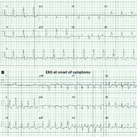 A And B Electrocardiographic Changes Obtain During Treadmill