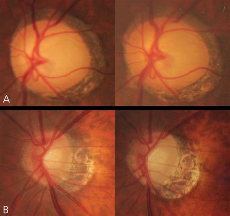 Peripapillary Atrophy In Glaucoma