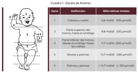 Diagnóstico Y Tratamiento De La Ictericia Neonatal Medcompendio