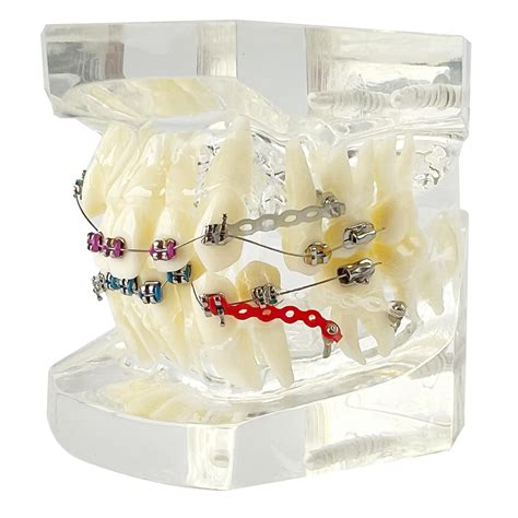 Amazon Orthodontic Demonstration Model With Stainless Steel