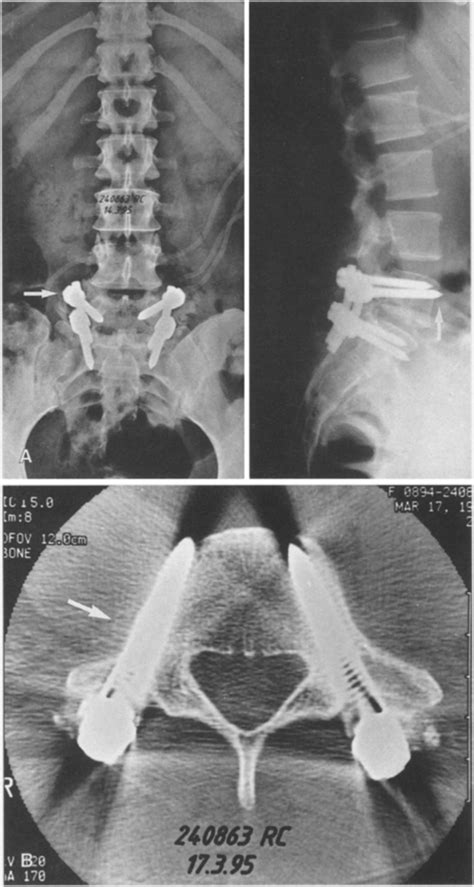 A Antero Posterior And Lateral Plain Radiographs And B L5 Ct Scan Slice Download Scientific