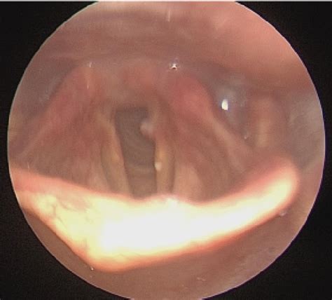 Figure 2 From Bilateral Vocal Cord Paralysis And Airway Obstruction