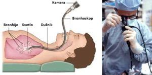 Bronhoskopija – proces, nalaz, rezultati, iskustva i cena