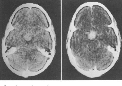 Table From Surgical Management Of Suprasellar Meningioma Part The