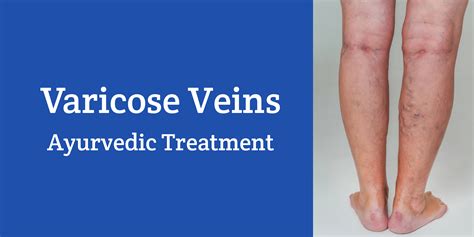 Varicose Veins Ayurvedic Treatment