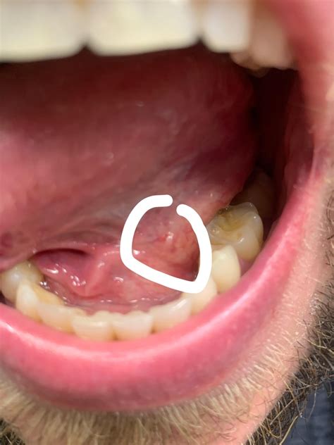 Little White Bump Under Tongue Rdentalhygiene