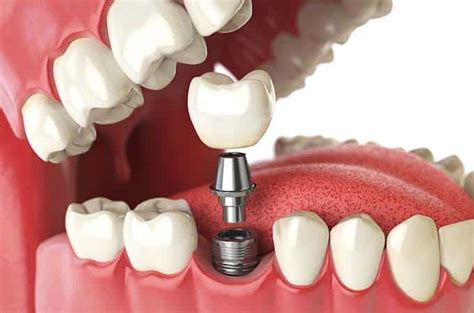 Direct Denture Pros And Cons Of Implant Dentures