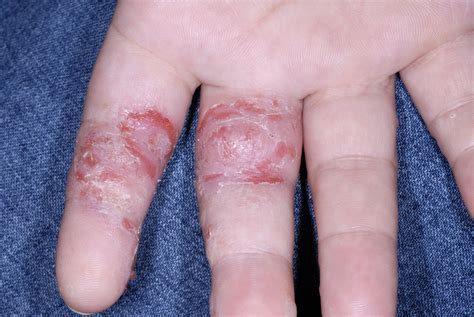 Eczema Causes Symptoms Treatments How To Get Rid Of Eczema Ph