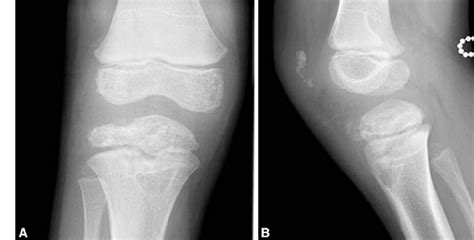 A B A Anteroposterior And B Lateral Radiographs Obtained At The