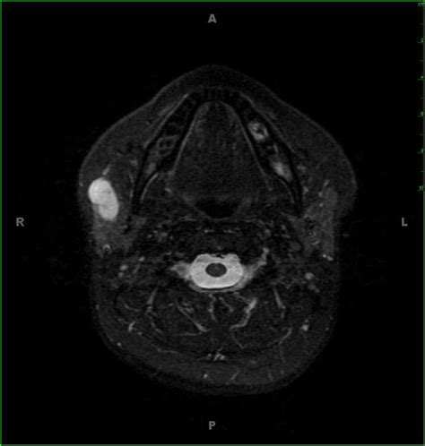 Benign Mixed Tumor Parotid Pleomorphic Adenoma Neuro MR Case