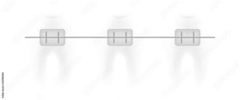 Correction Of Teeth With Orthodontic Braces Stages Of Teeth Alignment