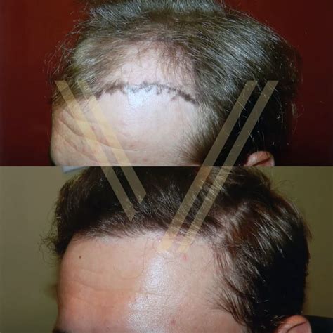 2000 Grafts Hair Transplant In Turkey Costs In 2024 Vantage