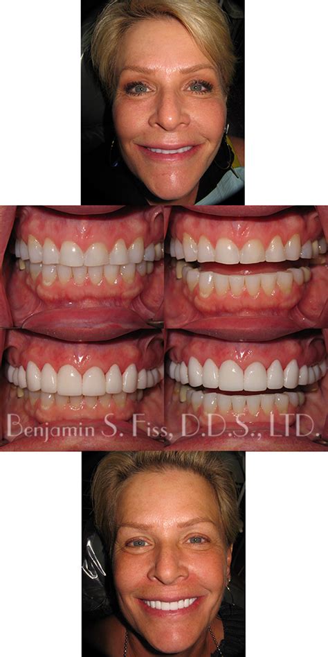 Porcelain Veneers In Chicago Il Chicago Benjamin S Fiss D D S