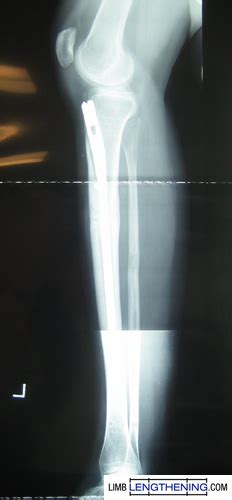 Tibia Lengthening With The LATN Technique