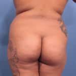 Brazilian Butt Lift Tampa Fl Bbl Surgery Fat Transfer Near Me