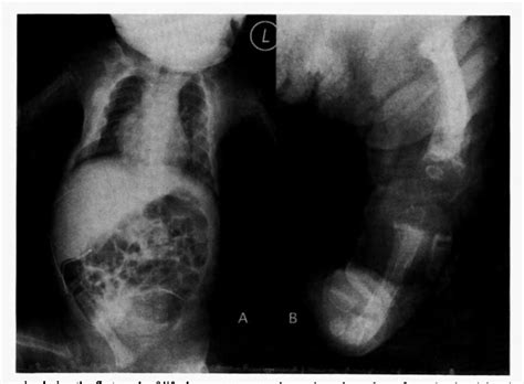 Figure 1 From Transient Neonatal Hyperparathyroidism A Presenting