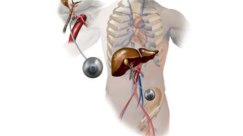 Hepatic Arterial Infusion Chemotherapy for Colorectal Liver Metastases ...