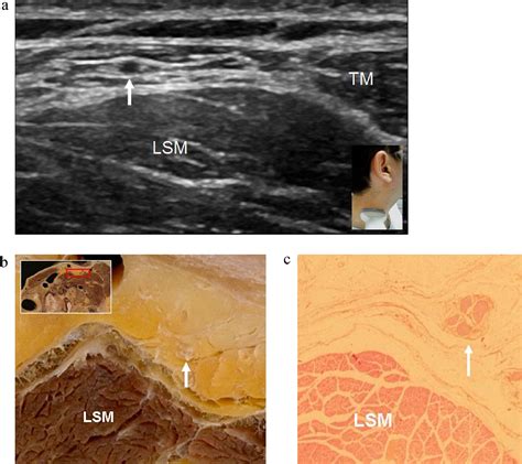 Anatomical Study Of Spinal Accessory Nerve Using Ultrasonography